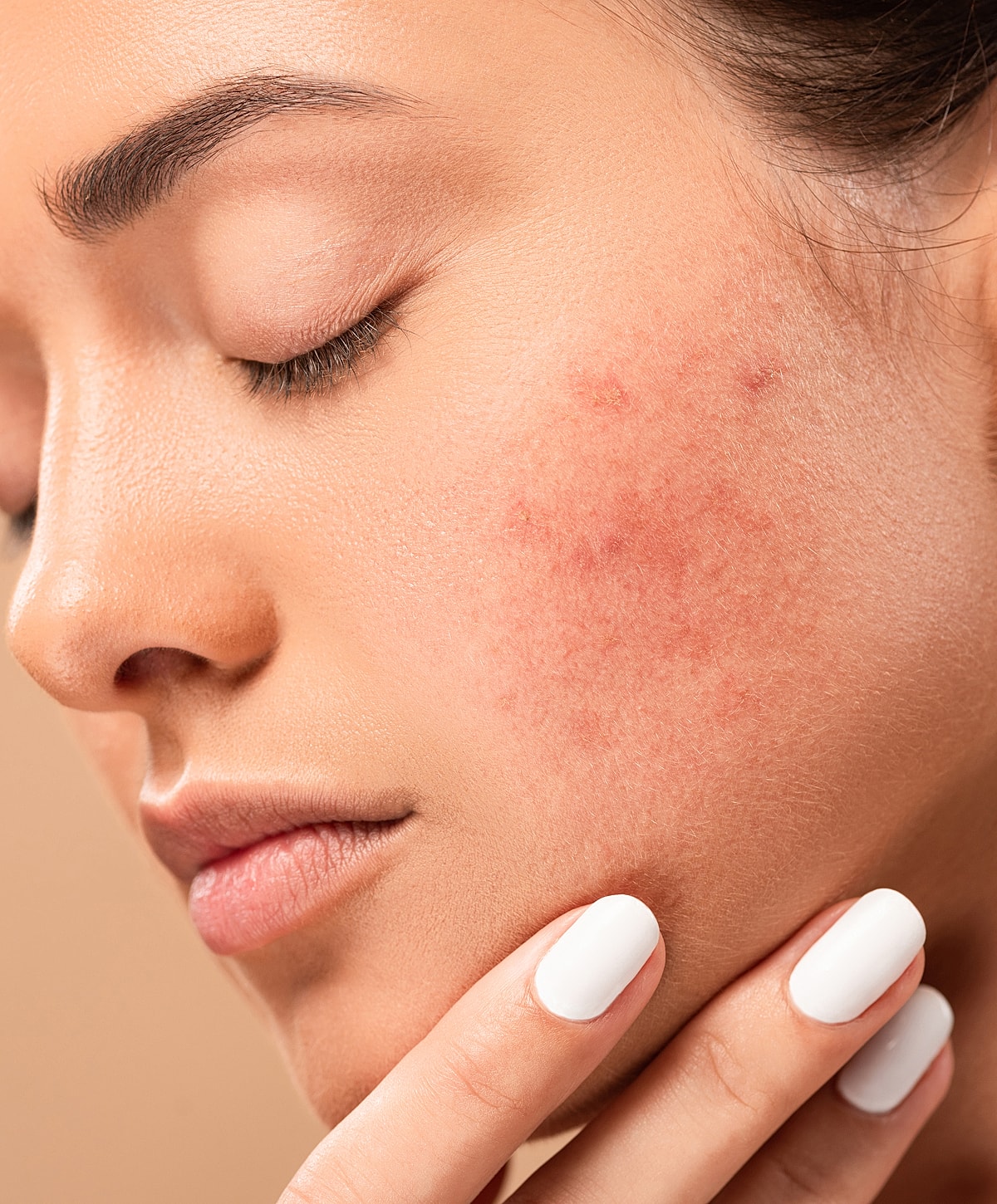 Close-up of skin with blemishes and redness.