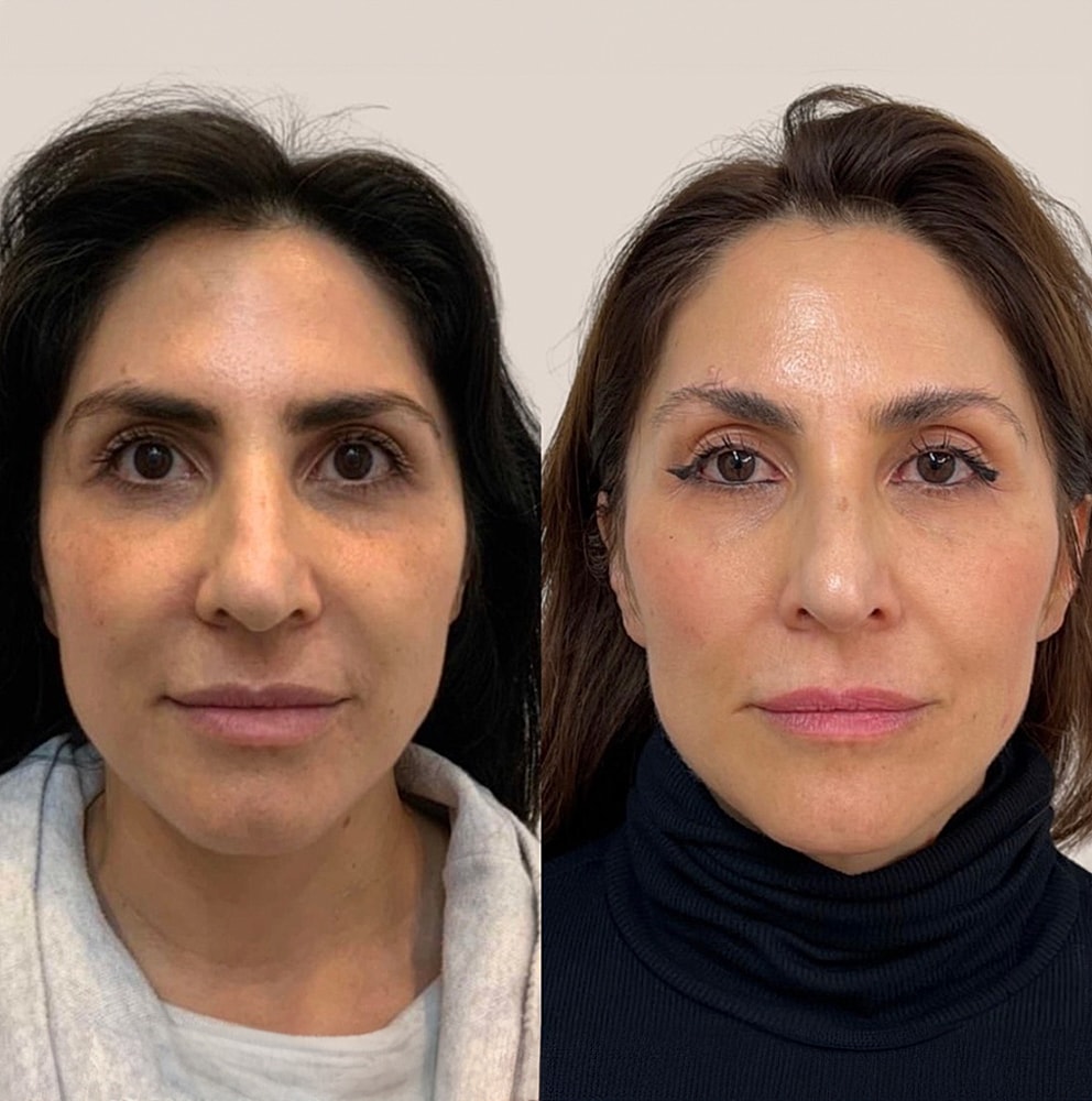 Before and after facial treatment comparison image.