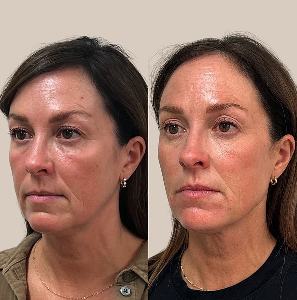 Before and after skincare treatment comparison photos.