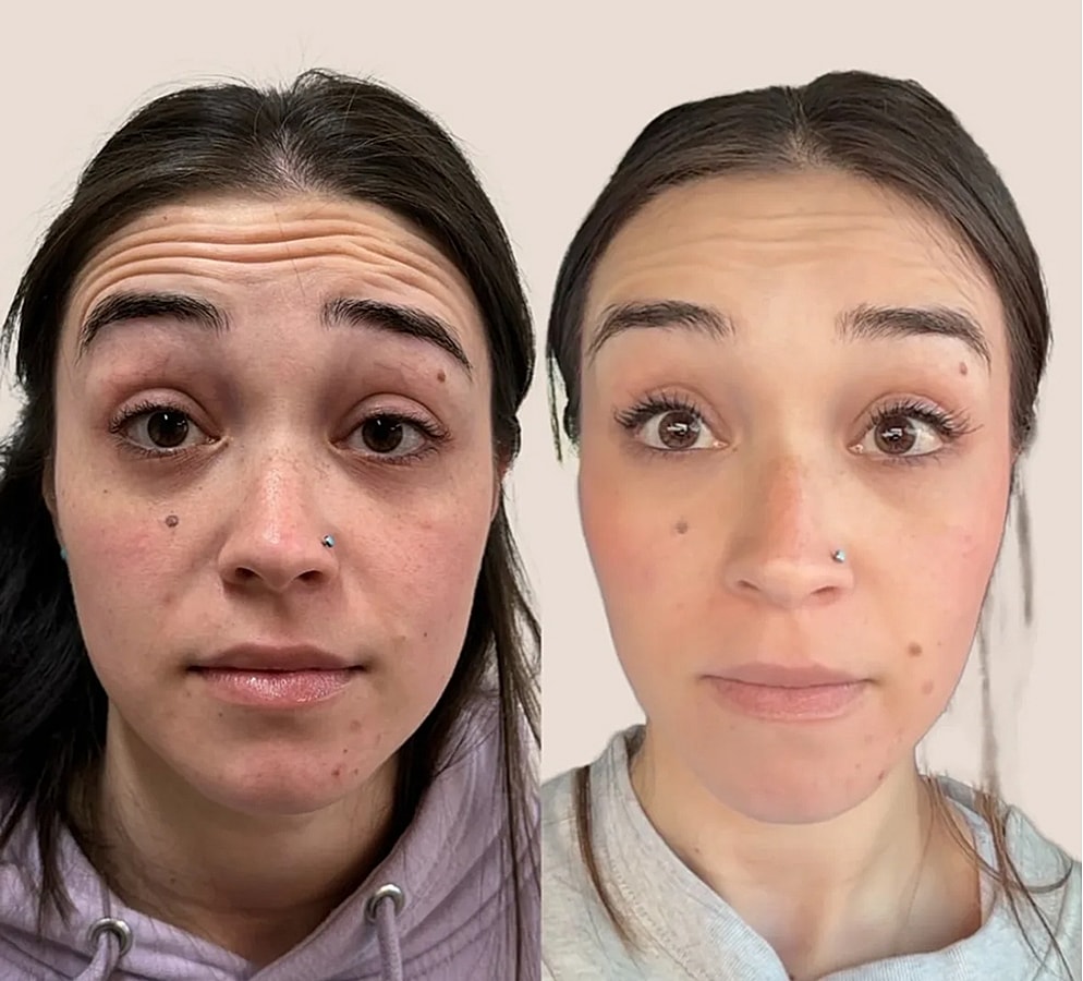 Before and after facial treatment comparison image.