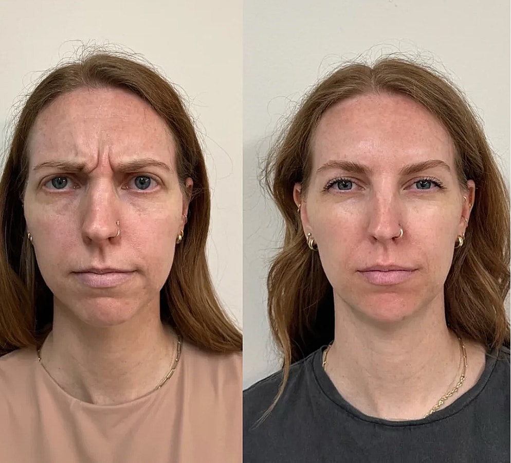 Before and after facial expression comparison.