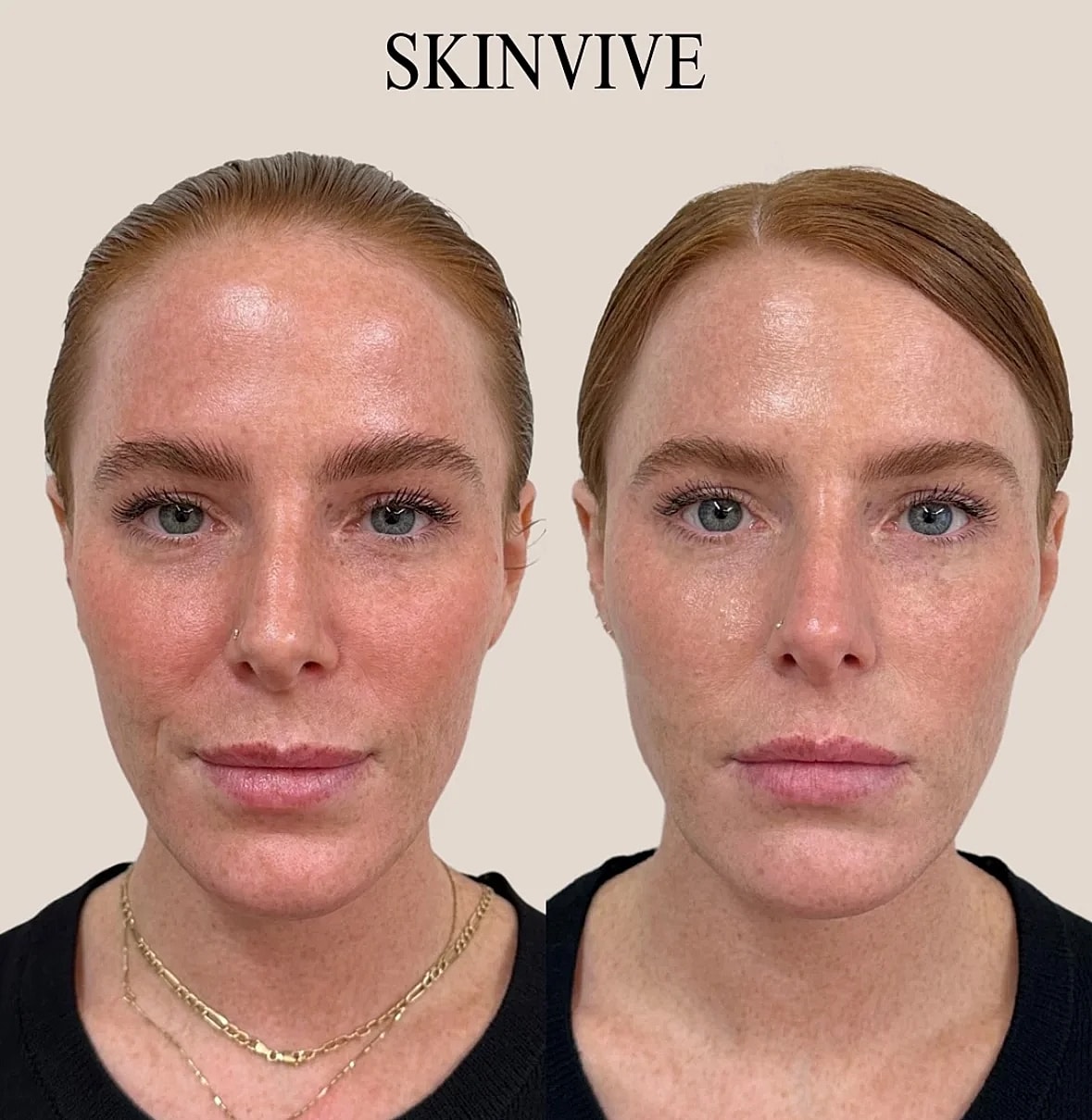 Before and after skin treatment comparison.